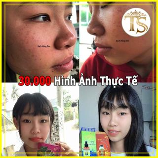 Tinh Chất Điều Trị Mụn Nám Bạch Hồng Đơn Xanh