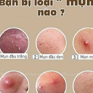 Trị mụn Linh Hương, combo trị mụn giá sốc.