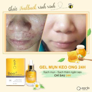 KEM TRỊ MỤN GEL ONG