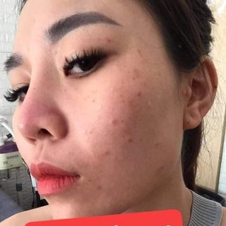 Serum trị mụn KING ACNE