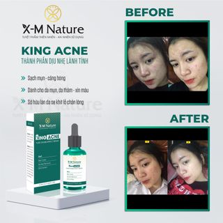 San pham tri mun - sieu pham King Acne cua XM Nature