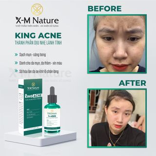 San pham tri mun - sieu pham King Acne cua XM Nature