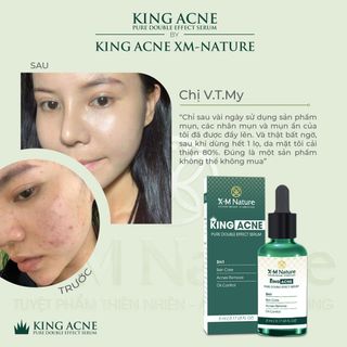 Vua trị mụn - King ance