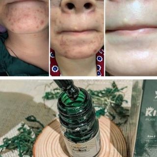 Serum Trị Mụn Chính Hãng XM_Nature