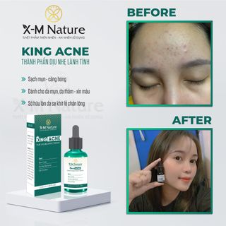 Vua trị mụn - King ance