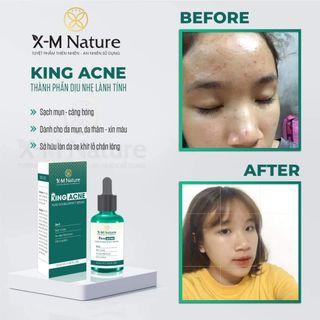 Serum trị mụn