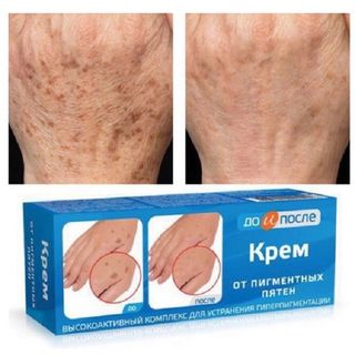 Kem trị đồi mồi tay kpem Nga,kem trị nám tàn nhang dưỡng da tay nga chính hãng