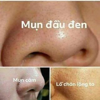 ĐẶC TRỊ MỤN AN TOÀN LÀNH TÍNH