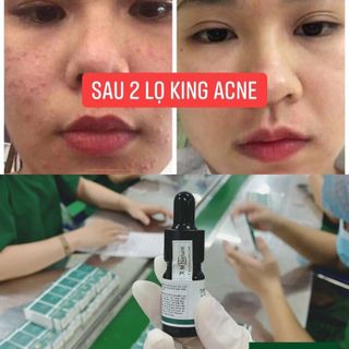 TRỊ MỤN CHÍNH HÃNG KING ACNE XM NATURE