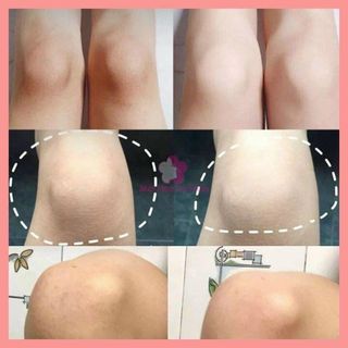 Xà hòng trị thâm mông, thâm nách, thâm đầu gối….