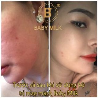 [HOT] Bộ Mao Mạch Baby Milk Phục Hồi Da Mỏng Đỏ Nhiễm Corticoid - Hàng Hiệu Cao Thiên Nhi