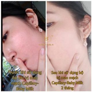 [HOT] Bộ Mao Mạch Baby Milk Phục Hồi Da Mỏng Đỏ Nhiễm Corticoid - Hàng Hiệu Cao Thiên Nhi