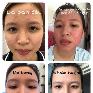 Thanh Dược Láre trị mụn nám tàng nhang sẹo rỗ 80ml
