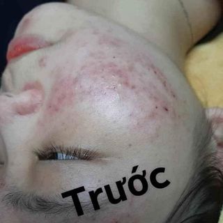 Kem trị mụn thuốc bắc timeless