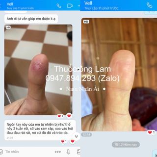 Tổ đỉa, chàm ngứa, ghẻ nước, nồm ăn tai, chàm sữa, mẩn ngứa, cơ địa Ông Lam
