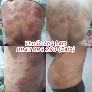 Tổ đỉa, chàm ngứa, ghẻ nước, nồm ăn tai, chàm sữa, mẩn ngứa, cơ địa Ông Lam