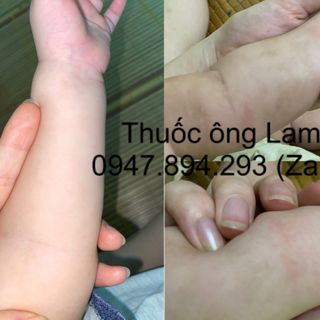 Tổ đỉa, chàm ngứa, ghẻ nước, nồm ăn tai, chàm sữa, mẩn ngứa, cơ địa Ông Lam