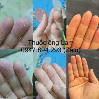 Tổ đỉa, chàm ngứa, ghẻ nước, nồm ăn tai, chàm sữa, mẩn ngứa, cơ địa Ông Lam