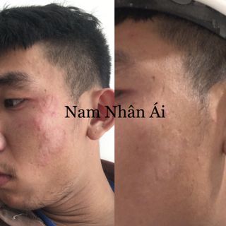 Hắc lào, nấm ngứa, nấm bẹn đông y gia truyền ông Lam