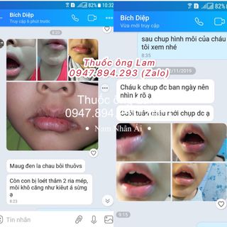 Thuốc chữa tổ đỉa, chàm sữa, chàm ngứa, viêm da, mẩn ngứa ông Lam