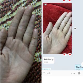 Thuốc chữa tổ đỉa, chàm sữa, chàm ngứa, viêm da, mẩn ngứa ông Lam