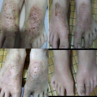 Thuốc chữa tổ đỉa, chàm sữa, chàm ngứa, viêm da, mẩn ngứa ông Lam