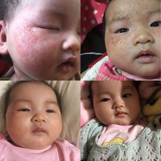Thuốc chữa tổ đỉa, chàm sữa, chàm ngứa, viêm da, mẩn ngứa ông Lam