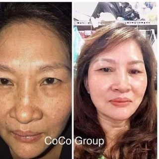 TÁI TẠO MIRACLE ĐẶC CHỊ MỤN - NÁM - TÀN NHANG - SẸO RỖ 30ML