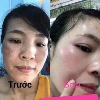 TÁI TẠO MIRACLE SKIN MỤN-NÁM-THÂM-TÀN NHANG-SẸO RỖ 50ml.