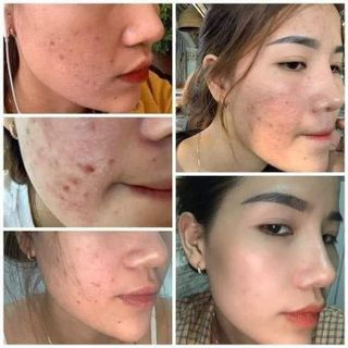 TÁI TẠO MIRACLE ĐẶC CHỊ MỤN - NÁM - TÀN NHANG - SẸO RỖ 30ML