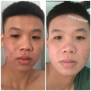 TÁI TẠO MIRACLE ĐẶC CHỊ MỤN - NÁM - TÀN NHANG - SẸO RỖ 30ML