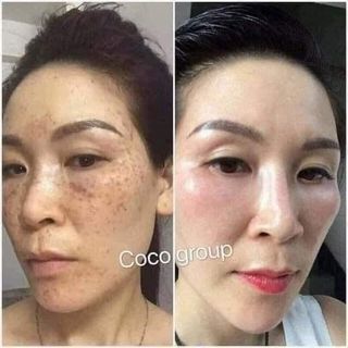TÁI TẠO MIRACLE ĐẶC CHỊ MỤN - NÁM - TÀN NHANG - SẸO RỖ 30ML