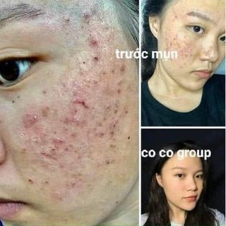 SERUM TÁI TẠO MIRACLE SKIN MỤN-NÁM-THÂM-TÀN NHANG-SẸO RỖ 50ml