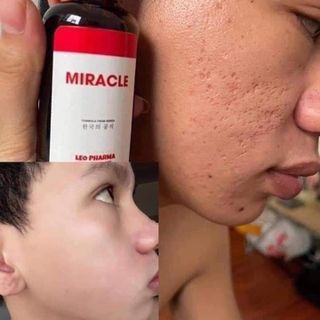 TÁI TẠO MIRACLE SKIN MỤN-NÁM-THÂM-TÀN NHANG-SẸO RỖ 50ml.