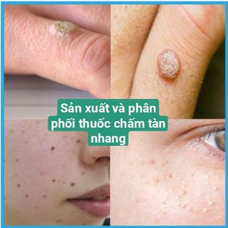 Thuốc chấm tàn nhang,mụn thịt,mụn cóc, đông y gia truyền, xuất sứ lào
