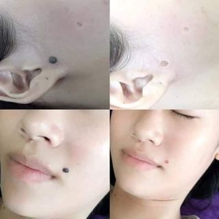 Độc quyền đông y trị dứt điểm tàn nhang