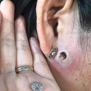 Độc quyền đông y trị dứt điểm tàn nhang