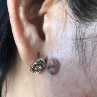 chấm tàn nhang đông y từ lào