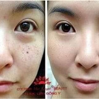 Thuốc chấm tàn nhang đông y gia truyền
