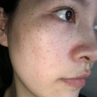 Chấm tàn nhang nốt ruồi Mụn thịt,Mụn cóc ,Đông Y gia truyền