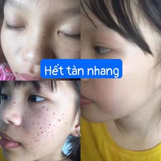 Chấm tàn nhang nốt ruồi Mụn thịt,Mụn cóc ,Đông Y gia truyền