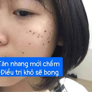 Chấm tàn nhang nốt ruồi Mụn thịt,Mụn cóc ,Đông Y gia truyền