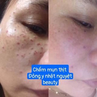 Chấm tàn nhang nốt ruồi Mụn thịt,Mụn cóc ,Đông Y gia truyền