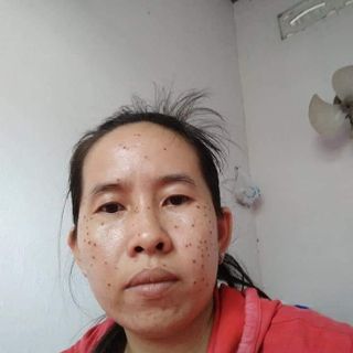 Chấm tàn nhang độc quyền gia truyền
