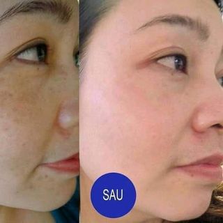 Chấm tàn nhang độc quyền gia truyền