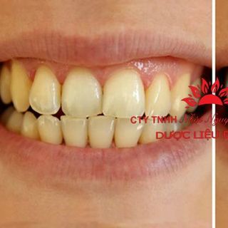 Tổng kho Bút tẩy trắng răng dazzling white