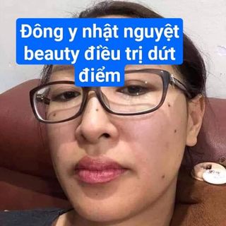 Thuốc chấm tàn nhang nốt ruồi đặc trị đông y gia truyền
