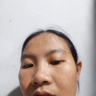Chấm tàn nhang độc quyền gia truyền