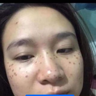 chấm tàng nhang nuốt ruồi đông y ra truyền