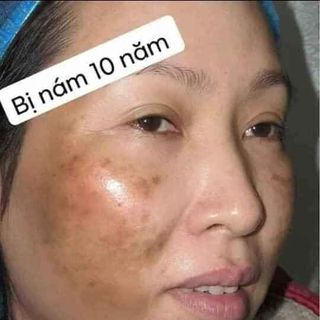 TÁI TẠO DA TRẺ HÓA DA ĐÔNG Y .ĐIỀU TRỊ MỤN .NÁM .TÀN NHANG .TRẺ HÓA DA